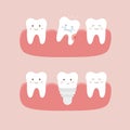 The process of tooth extraction and implantation. Cute ÃÂartoon teeth. Dental personage vector illustration