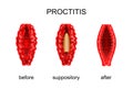 Proctitis. before and after treatment of rectal suppositories