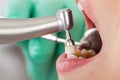 Professional dental cleaning