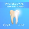 Professional Teeth Whitening, Healthy and yellow Tooth