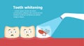 Professional teeth whitening vector illustration
