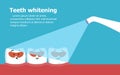 Professional teeth whitening vector illustration