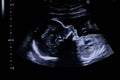 Profile of the 20 weeks old baby fetus face and chest during a halfway ultrasaound examination Royalty Free Stock Photo