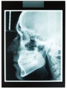 Profile xray of man jaw for dentist