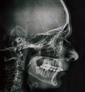 Profile xray of man jaw