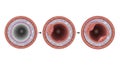 Progression of atherosclerosis in an artery cross section Royalty Free Stock Photo