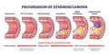 Progression of atherosclerosis and thrombosis formation outline diagram