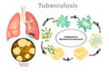 Progression of pulmonary tuberculosis Royalty Free Stock Photo