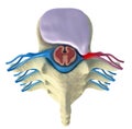 Prolapse of intervertebral disc Royalty Free Stock Photo