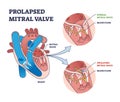 Prolapsed mitral valve heart disease comparison with normal outline diagram Royalty Free Stock Photo