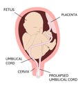 Prolapsed umbilical cord. umbilical cord comes out of the uterus with or before the presenting part of the baby