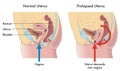 Prolapsed uterus