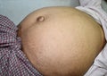 Prominent abdominal distension in Southeast Asian, Myanmar man. Left lateral view.