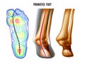 Pronated foot, arch deformation, bottom and back view . Foot weight distribution. Royalty Free Stock Photo