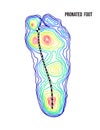 Pronated foot, arch deformation, bottom view. Foot weight distribution.