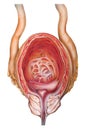 Prostate - Benign Prostatic Hypertrophy