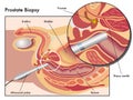 Prostate biopsy Royalty Free Stock Photo