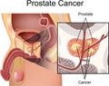 Prostate Cancer