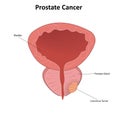 Prostate cancer vector illustration Royalty Free Stock Photo