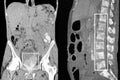 Prostate cancer, bone metastases. CT-scan reconstruction.