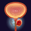 Prostate cancer, illustration