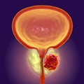 Prostate cancer, illustration