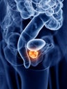 Prostate cancer Royalty Free Stock Photo