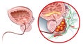 Prostate cancer and healthy prostate, medically accurate illustration