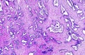 Prostate cancer of a human