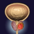 Prostate cancer illustration