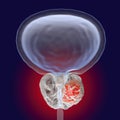 Prostate cancer illustration