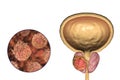 Prostate cancer, illustration