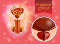 Prostate Cancer Realistic Vector Anatomical Scheme Royalty Free Stock Photo