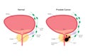 Prostate cancer concept