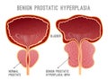 Prostate Disease Infographic