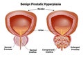 Prostate Enlarged with Benign Hyperplasia Royalty Free Stock Photo