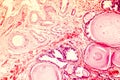 Photomicrograph of prostate hyperplasia