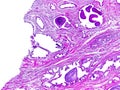 Prostate hypertrophy of a human