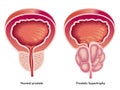 Prostatic hypertrophy