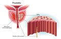 Prostatitis