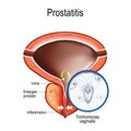 Prostatitis and close-up of Trichomonas vaginalis Royalty Free Stock Photo