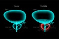 Prostatitis inflammation problem