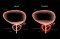 Prostatitis inflammation problem