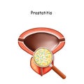 Prostatitis. Male bladder and prostate