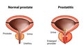 Prostatitis