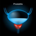 Prostatitis. Red Prostate gland and blue realistic bladder Royalty Free Stock Photo