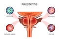 Prostatitis. sexual infections