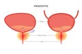 Prostatitis inflammation problem