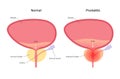 Prostatitis inflammation problem