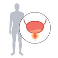 Prostatitis inflammation problem